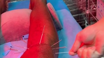 Dus jij wil acupunctuur?